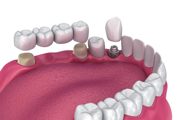 Fixed teeth | Finedent dental clinics