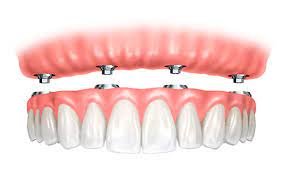 Implant-supported complete dentures | Finedent dental clinics