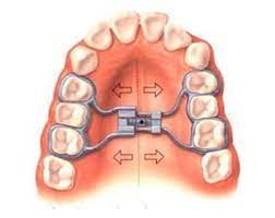 Rapid maxillary expansion | Finedent dental clinics