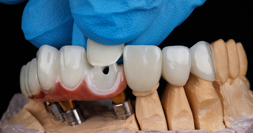 Best dental Crowns 