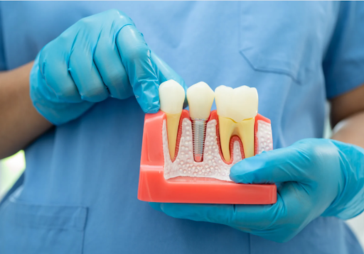 Dental implants in hyderabad