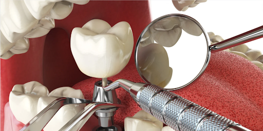 Dental implants in hyderabad