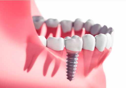Dental Implants in Hyderabad