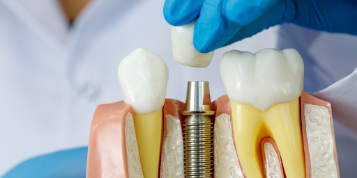 Best Dental Implants in Hyderabad