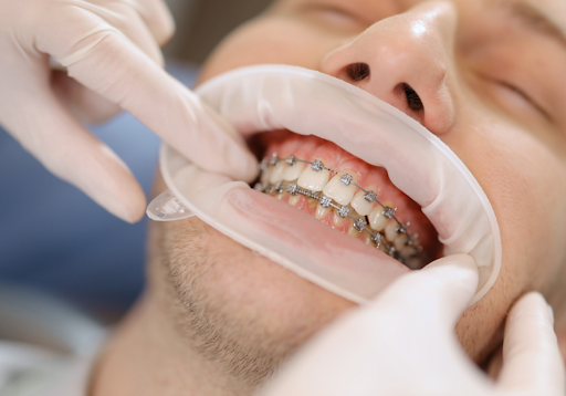 Orthodontic Treatment in hyderabad