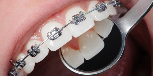 Orthodontic Treatment in Hyderabad 