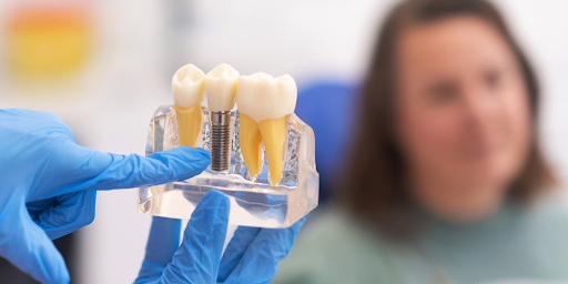 Best Dental Implant Clinic in Hyderabad 