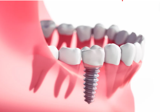 Best Dental Implants