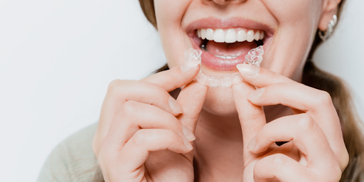 Clear Aligners in Nallagandla