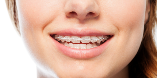 Clear Braces in Hyderabad