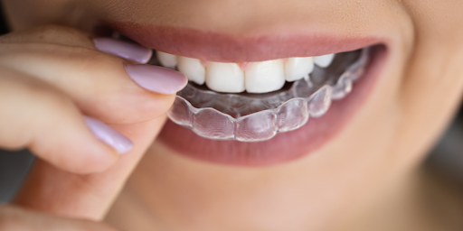clear aligners nallagandla