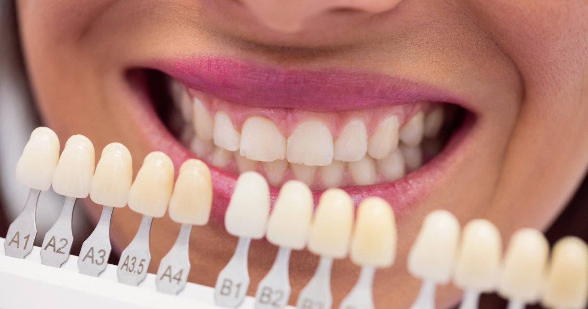 Teeth Whitening in Nanakramguda
